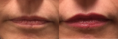 Lip rejuvenation with Volbella and Botox - Volbella and a small amount of Botox on the cupid's bow gave this 61 year old patient the fuller, more uplifted lip she wanted.