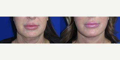 Woman treated with Nonsurgical Facelift, Nonsurgical Neck Lift - This patient wanted to refresh her appearance and came to us with concerns about the droopiness in her cheeks, sagging skin in her neckline, and jowls in her lower face.The FaceologyLIFT was performed to lift, tighten, and restore her lower face and neck. This procedure enhanced and revitalized her appearance while restoring her self-confidence.