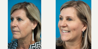 45-54 year old woman treated with Facelift - Advanced Lift plus Upper Eyes