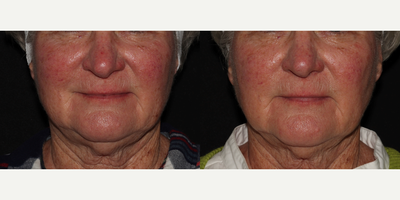 55-64 year old woman treated with Laser Genesis, Excel V - Patient was treated with laser treatments to clear up skin and treat rosacea / redness.