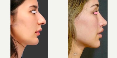 25-34 year old woman treated with Facelift, Rhinoplasty, Lip Lift, Facial Fat Transfer, Brow Lift - Young woman who underwent an endoscopic mid-face lift, rotational endoscopic brow lift, lip lift, fat transfer and rhinoplasty