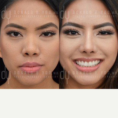 Asian Rhinoplasty with rib cartilage and DCF - Before and After surgical Asian rhinoplasty with rib cartilage and diced cartilage fascia (DCF) to lengthen and refine the nose. Alar base modification was performed to subtly narrow and refine the nostrils.