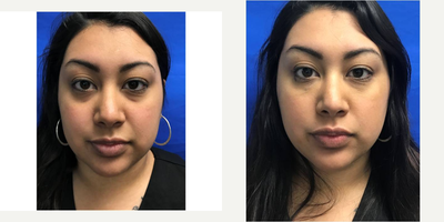 18-24 year old woman treated with Non Surgical Face Lift - Female hispanic patient showing circles under eyes and lines along nasal labial folds. Treated with Belotero under-eyes and Juvederm in cheeks. Under eye circles diminished and nasal labial folds not as prominent.