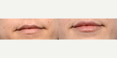 35-44 year old woman treated with Restylane Kysse - Nurse Practitioner Radhika used Restylane Kysse to subtly enhance this patient's lips, to add fullness but keep the natural shape. After photos taken 2 weeks post- lip injections.