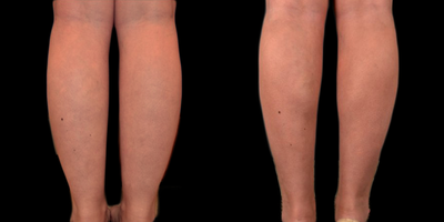 18-24 year old woman treated with Tumescent Liposuction - Hi definition water assisted (BodyJet) and ultrasound assisted (VASER) contouring of the legs including the inner and outer thighs for lipedema, a genetic condition of disproportionate fat cells with associated pain and swelling.