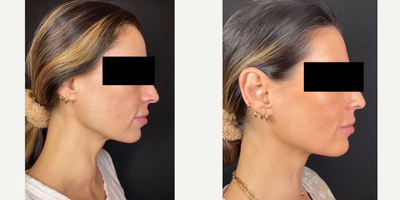 35-44 year old woman treated with Clear and Brilliant, Microneedling RF, Neo Laser, Facial - This patient had amazing results with the following treatments:- Clear and Brilliant, 2 sessions- NeoAerolase Rejuvenation, 1 sessions- Tixel, 2 sessions- Magic Hour Facial, 4 sessions