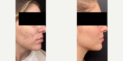 25-34 year old woman treated with Neo Laser - This patient had amazing results with the following treatments:- NeoAerolase, 1 session- SkinPen Microneedling, 2 sessions- BioRepeel Blue, 6 sessions- Magic Hour Facial, 4 sessions