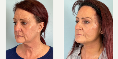 1 Week Post- Op Facelift, Neck Lift, Facial Fat Transfer, Chin Implant - 1 Week Post- Op Facelift, Neck Lift, Facial Fat Transfer, Chin Implant