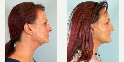 1 Week Post- Op Facelift, Neck Lift, Facial Fat Transfer, Chin Implant - 1 Week Post- Op Facelift, Neck Lift, Facial Fat Transfer, Chin Implant