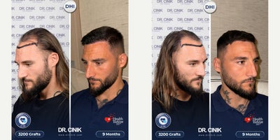 25-34 year old man treated with DHI Hair Transplant - For the well-known football player Nemanja Gudelj, a total of 4700 grafts were transplanted using the DHI technique, with implantation focused on the frontal, mid-scalp, and crown areas to achieve balanced density and natural coverage.