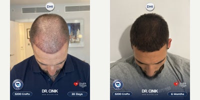 25-34 year old man treated with DHI Hair Transplant - For the well-known football player Nemanja Gudelj, a total of 4700 grafts were transplanted using the DHI technique, with implantation focused on the frontal, mid-scalp, and crown areas to achieve balanced density and natural coverage.
