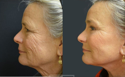Woman treated with Facial Fat Transfer - Woman treated with Facial Fat Transfer.