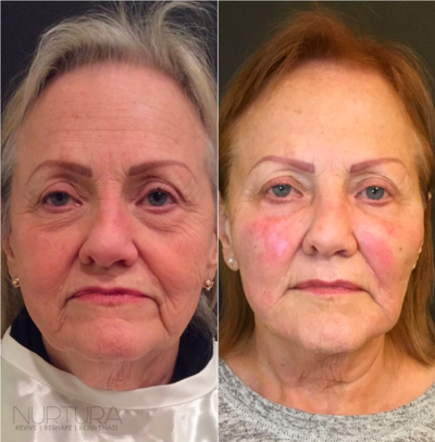 The Nu Face Procedure -- All Natural Fat Transfer, exclusively at Nurtura - As we get older and lose collagen, or experience weight loss, volume in the skin is depleted and the structural integrity of the skin's tissue is compromised. The Nu Skin Rejuvenation Procedure utilizes your own regenerative cells and fat tissue to replace volume loss in the face and body. Exclusively at Nurtura, the Nu Procedure is a revolutionary way to naturally reverse the signs of aging with minimal to no downtime
