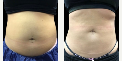 CoolSculpting - CoolSculpting Elite is a safe and effective treatment to remove unwanted fat from almost any part of your body.