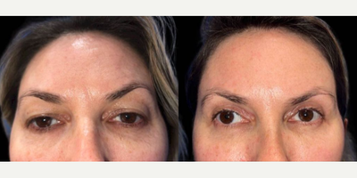 Woman treated with Eyelid Surgery, Brow Lift - This combination procedure of a blepharoplasty and brow lift involves addressing two distinct areas to achieve a more youthful and refreshed appearance. A brow lift elevates and tightens the forehead skin, reducing wrinkles and lifting the eyebrows, creating a smoother, rejuvenated look. During blepharoplasty, excess skin and fat are removed to eliminate drooping and puffiness. This comprehensive approach targets both the upper face and eye region, providing natural harmonious results.