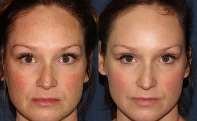 35-44 year old woman treated with Fraxel Laser - Fraxel Dual laser is used to treat facial pigmentation and uneven skin tone on a female patient.