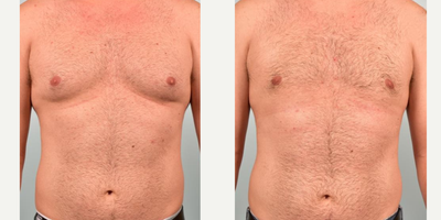25-34 year old man treated with Gynecomastia Surgery - This patient is a 29-year-old male who presented to my Scottsdale office with complaints of excess fullness in the chest consistent with gynecomastia. He also had lateral chest fullness as well. I recommended a bilateral correction of gynecomastia with power-assisted liposuction and direct glandular tissue resection as well as power-assisted liposuction of lateral chest.In surgery I performed this combination of surgery which included over 50 grams of glandular tissue removal per side. After surgery the patient was verry happy with his flatter, more masculine appearing chest and he reported a significant boost in his self-confidence.