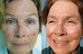 Skin Resurfacing Using Plasma Rejuvenation with Portrait - 
	Skin Resurfacing using Plasma rejuvenation with Portrait

	Before: Sun damage Wrinkling Uneven tone The result at 2 years after Portrait plasma rejuvenation treatment is shown. In addition to the obvious cosmetic benefits, Portrait Plasma Rejuvenation has the added benefit of treating pre-cancerous skin lesions.
