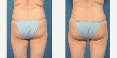 35-44 year old woman treated with Butt Lift - Pt desired to sculpt and add subtle volume to her lower buttocks, she had liposuction of flanks and bra line and fat transfer to buttocks.