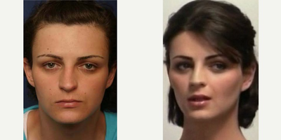 Facial Feminization Surgery - Voice Modification, Tracheal Shave, Radiesse to Cheeks, Hairline Forehead Lift with Hairline Lowering, Orbital Bony Contouring, Rhinoplasty and Lip Augmentation25-34 Year Old
