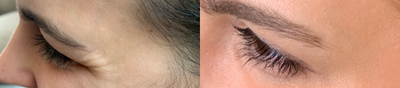 25-34 year old woman treated with Botox - Botox to treat crow's feet.