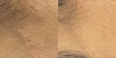 25-34 year old woman treated with Scar Removal - 27 year old female underwent scar revision surgery under local anesthesia.