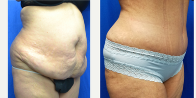 45-54 year old woman treated with Tummy Tuck - 53 year old female two months after a tummy tuck. She was 5 feet 3 inches and 165 lbs. She has 3 children. After surgery, her weight is 149 lbs and she went from a size 16 to a size 10.