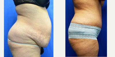 45-54 year old woman treated with Mommy Makeover - The patient is a 53 year old female two months after a tummy tuck as part of her mommy makeover. She was 5 feet 3 inches and weighed 165 lbs. before surgery. She has 3 children. Her weight after surgery is 149 lbs and she went from a size 16 to a size 10. No liposuction was done.