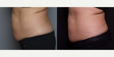 45-54 year old woman treated with SculpSure - This patient came in wanting to contour her abdomen. After consulting with one of our aestheticians, the patient elected to have a SculpSure treatment.