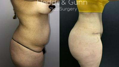 25-34 year old woman treated with Brazilian Butt Lift - BBL/Tummy Tuck