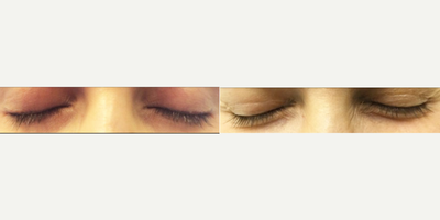 25-34 year old woman treated with Laser Surgery for Tattoo Removal - Permanent eyeliner tattoo removal - Post 3rd PicoSure Laser Tattoo removalCompletely resolved permanent eyeliner tattoo