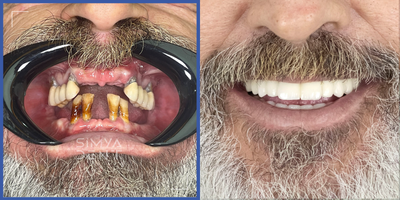 55-64 year old man treated with All-on-4 Dental Implants - Our patient had serious perodontal disease which led to tooth and bone loss. The condition of existing teeth were not healthy. Therefore all-on-4 treatment has been applied and he had been able to eat and smile healthy.