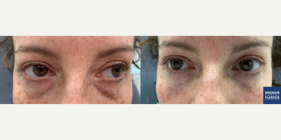 Woman treated with Belotero - Woman treated with Belotero filler in the tear trough (under eye) to get rid of under eye hollowness.