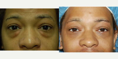 25-34 year old man treated with Eyelid Surgery - Lower lid transconjunctival (no skin incision ) blepharoplasty.