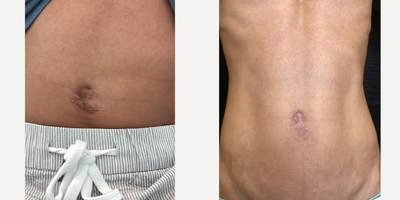 35-44 year old man treated with Morpheus8 and Lumecca - 1-month progress picture of a 35-year old male treated with Morpheus8 and Lumecca for an abdominal scar. This client wanted to improve the look of a scar he's had all his life. After just one session of Morpheus8 and Lumecca IPL, we can see great improvement. He will come back for 2 more sessions to continue the results!