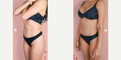 35-44 year old woman treated with Mommy Makeover, Tummy Tuck, Breast Lift with Implants - 35-44 year old woman treated with Mommy Makeover, Breast Lift with Implants, Tummy Tuck