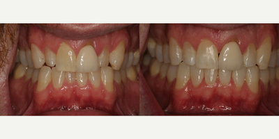 25-34 year old man treated with Clear Braces - 10 months treatment time with Invisalign