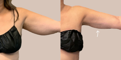 35-44 year old woman treated with AirSculpt - Patient received airsculpt fat removal on her arms in our Charlotte location. Results are 3 months post-op.