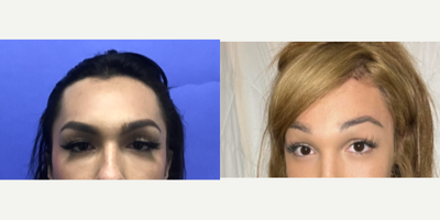 Patient treated with Forehead Reduction, Brow Lift - Forehead Lift, Hairline Lowering, Orbital Bony Contouring - 18 to 24 year-old female patient is 1 year post-op from Facial Feminization surgery. Her procedures included: Forehead Lift, Hairline Lowering, Orbital Bony Contouring, Septorhinoplasty (open) with Cartilage Grafts and Radix Graft, Cheek Implants (small), Chin Implant (custom carved central) with Reduction and Contour, Soft Tissue to Nasolabial Folds and Pyriform, Intranasal Lip Lift with Fat Augmentation to Upper Lip, Thyroid Cartilage Shave and Voice Feminization, Submental Liposuction, 300 Micrografts, and 1cc Voluma to Medial Cheeks.