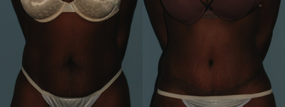 Patient underwent an Abdominoplasty - 
	Age:30 Height:5'5 Weight:155 Post-op Timeframe: 1 mo post op
