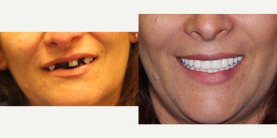 45-54 year old woman treated with All-on-4 Dental Implants - All-on-4 Dental Implants