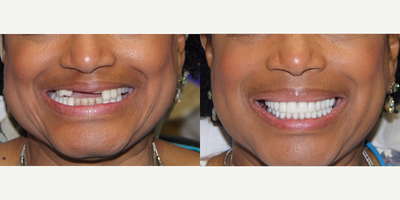55-64 year old woman treated with All-on-4 Dental Implants - All-on-4 Dental Implants