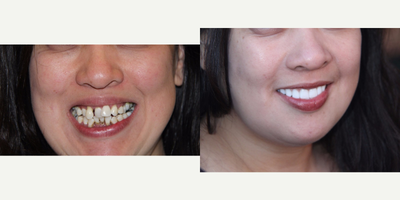 25-34 year old woman treated with All-on-4 Dental Implants - All-on-4 Dental Implants