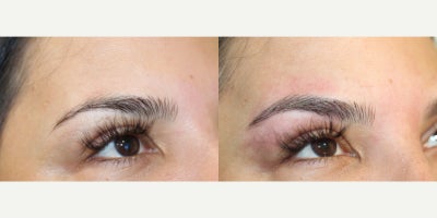35-44 year old woman treated with Microblading, Permanent Makeup - Microblading is a precision-based form of cosmetic tattooing designed to enhance and restore natural brow shape. Each treatment is performed by Ruth Swissa, CMM, a leading expert in medical micropigmentation.Using a sterile, single-use microblade, ultra-fine pigment is deposited into the superficial dermis to create realistic, hair-like strokes that blend seamlessly with existing brow hair. Each procedure includes a detailed facial analysis and custom brow mapping to ensure symmetry, balance, and a tailored result.Ideal for patients with thinning brows, asymmetry, or hair loss, microblading delivers soft, natural-looking enhancement with results that continue to refine as the pigment settles. *A follow-up session is recommended to perfect the final outcome.