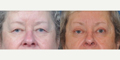 Woman treated with Eyelid Surgery - Woman treated with Eyelid Surgery