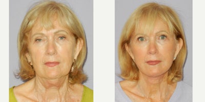 65-74 year old woman treated with Facelift, MACS Facelift, Eyelid Surgery - 74 yo woman with previous Bells palsy undergoing modified MACS facelift