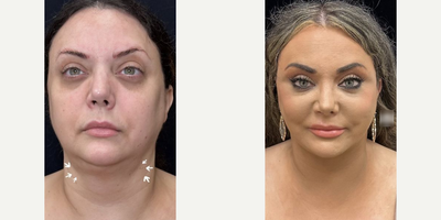 Woman treated with Deep Plane Facelift, Neck Lift, Buccal Fat Removal, Facial Fat Transfer - Woman treated with Deep Plane Facelift, Neck Lift, Buccal Fat Removal, Facial Fat Transfer