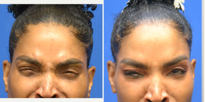 55-64 year old woman treated with Daxxify - Improved frown lines/ glabella and forehead