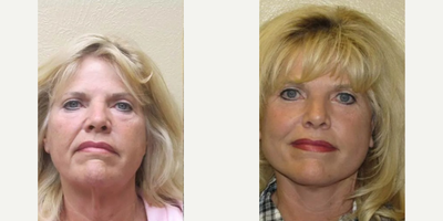 Woman treated with Facelift - Woman treated with Facelift