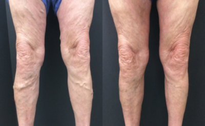 65-74 year old man treated with Varithena - Varithena, a phlebectomy, and sclerotherapy.
